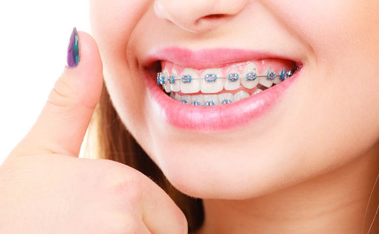 تقويم الاسنان من اجل ابتسامة مشرقة